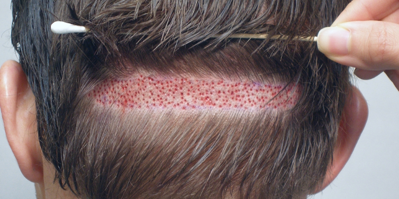 Follicular Unit Transplantation (FUT)