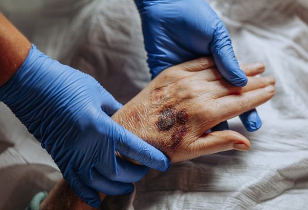 A bruise on the hand of an elderly person. Known as senile purpura. Caused by the fragility of the skin and blood vessels in old age. Elderly care