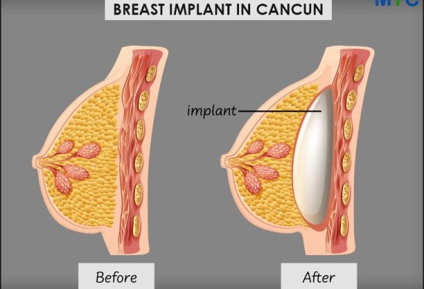 Cancun-breast-implant